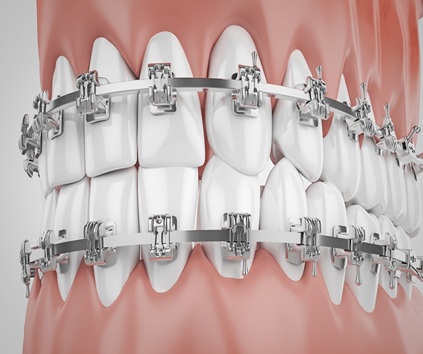 Dental Braces Consultation