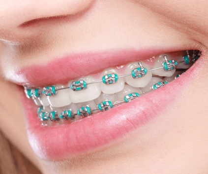 Dental Braces Treatment