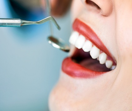 Dental Bonding Treatment