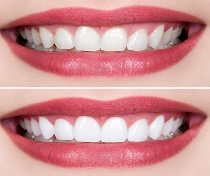 Dental Veneers Before and After