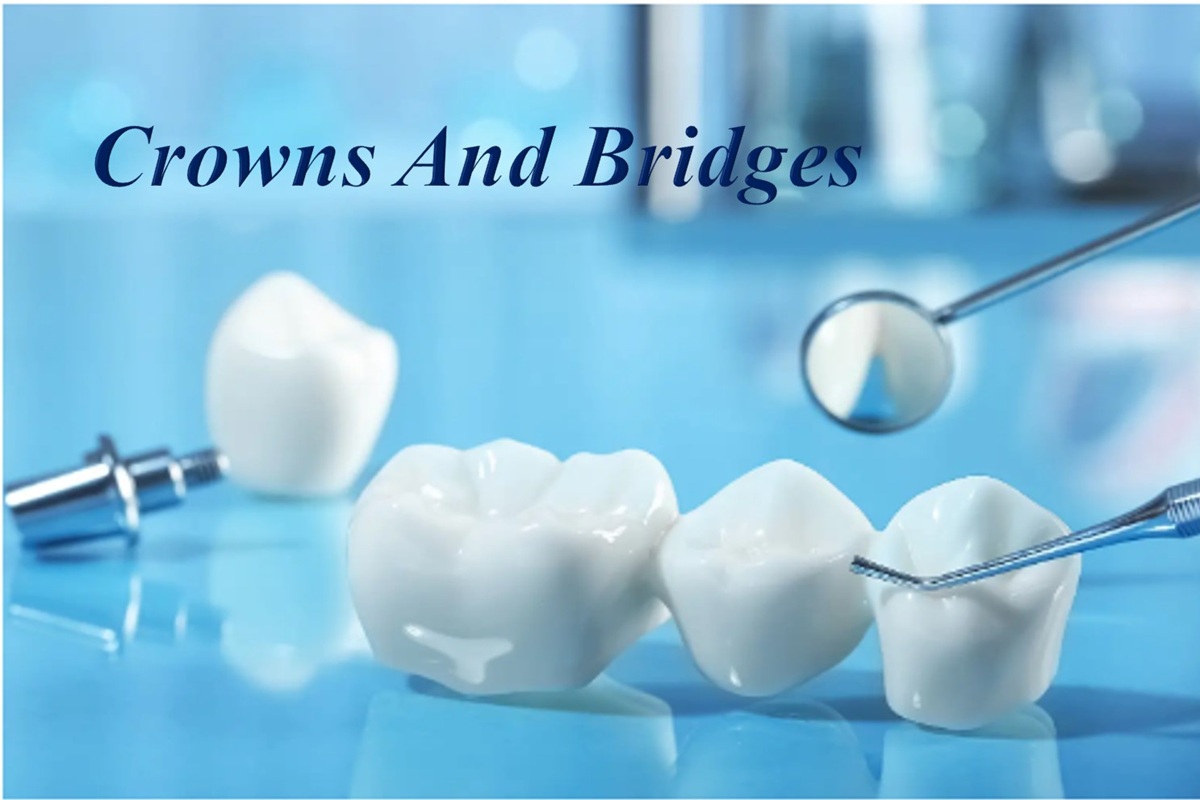 Dental Crowns & Bridges Consultation