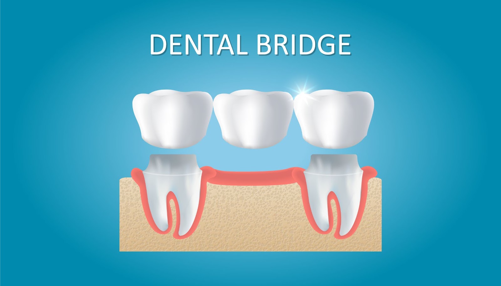 Dental Bridges at Root Care Dental Clinic